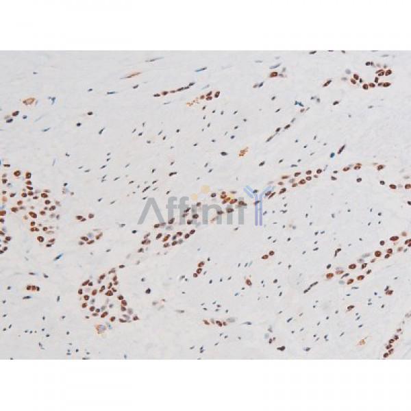 Phospho-NF-kB p65 (Ser281) Antibody - AF3393 at 1/200 staining Human bladder cancer tissue sections by IHC-P.